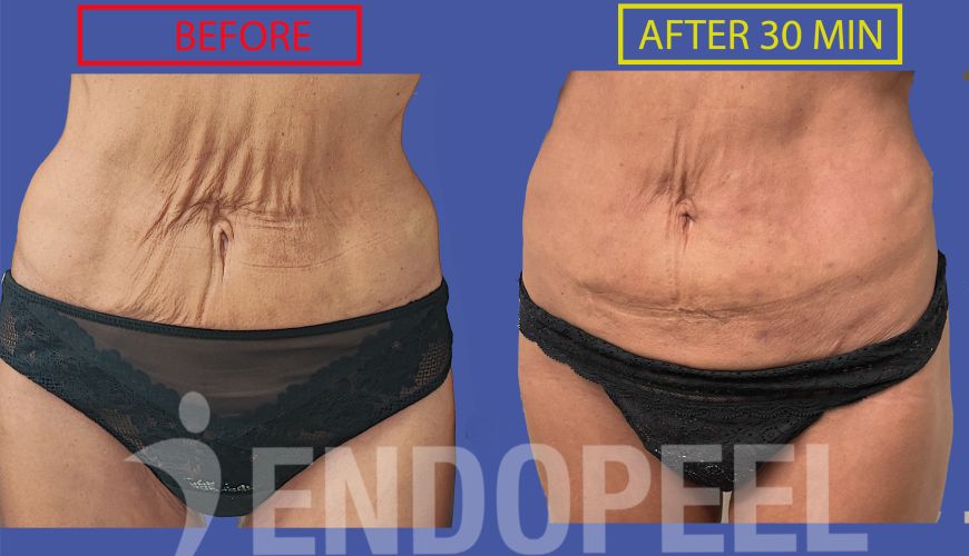 female abdominoplasty